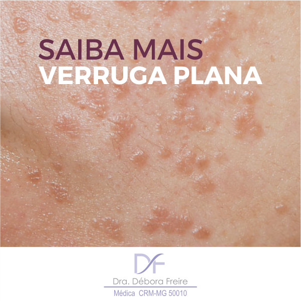 Verruga plana